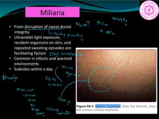 Miliaria
• From disruption of sweat ductal
integrity
• Ultraviolet light exposure,
resident organisms on skin, and
repeated sweating episodes are
facilitating factors
• Common in infants and warmed
environments
• Subsides within a day
moshi
dearie Milian
US
Milio
Tone sweatdish
Cloud
wnlooonnio m.ie
Tourisick
lifinson
101m 400
2
aug monsoon
nN
2mi
 