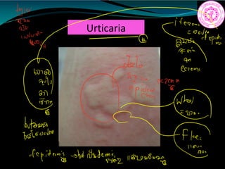 Urticaria
M
thic
ON
9
Titian
182
831 e
2111
epidi
C
button
flu
badoo.no
fepidermisy but
interdepin 110012562
 