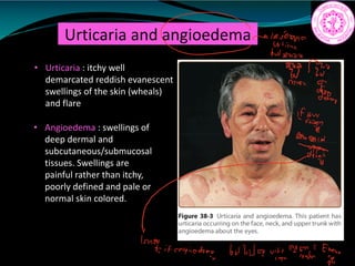 Urticaria and angioedema
• Urticaria : itchy well
demarcated reddish evanescent
swellings of the skin (wheals)
and flare
• Angioedema : swellings of
deep dermal and
subcutaneous/submucosal
tissues. Swellings are
painful rather than itchy,
poorly defined and pale or
normal skin colored.
flavono
It'sb
200 Pro
Inn
Fem
IEY.EE
881
11
n
if angioedema
butbvavityettaifh.gs
 
