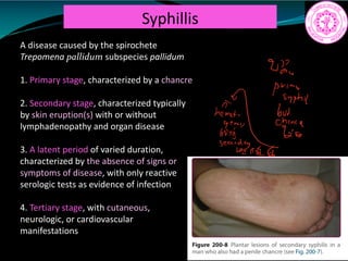 Syphillis
A disease caused by the spirochete
Trepomena pallidum subspecies pallidum
1. Primary stage, characterized by a chancre
2. Secondary stage, characterized typically
by skin eruption(s) with or without
lymphadenopathy and organ disease
3. A latent period of varied duration,
characterized by the absence of signs or
symptoms of disease, with only reactive
serologic tests as evidence of infection
4. Tertiary stage, with cutaneous,
neurologic, or cardiovascular
manifestations
prime
syphil
Iis
 