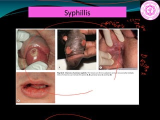 Syphillis
a
 