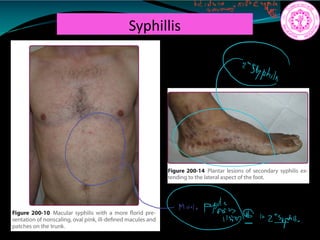 Syphillis
but
ifeng.nttesyp.IE
a
a
mail.PH
Iin2 syhit
 