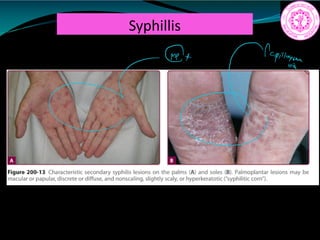 Syphillis
Papillae
I
 