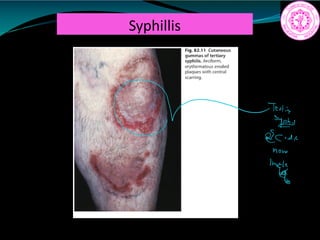 Syphillis
cadic
have
Ee
 