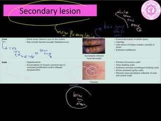 Secondary lesion
it
c
Gray
Primalesio
Minin
meet she
a
Tisguinance
SEE
 