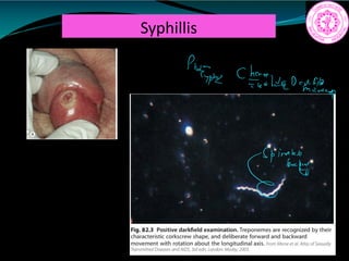 Syphillis
Phone Chei lead in p
a
 