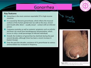 Gonorrhea
a
 