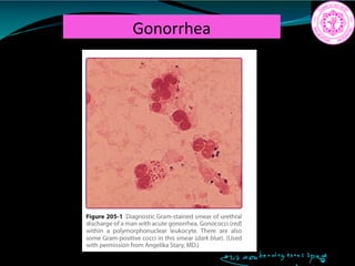 Gonorrhea
togenousspread
 
