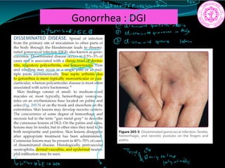 Gonorrhea : DGI
2naNIINONT.in
8ai
i
1242224526C
Gillimined gentle than
9
Trial in
mintg.to
rtnritti Gi
tarkbdinnot
 