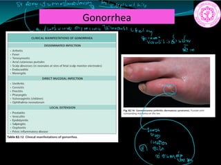 Gonorrhea
S4 Gore it wmadavauavinty.be septi at hits
a it was une anzhecritic1211420654
feeling
it is
Effi
c
 