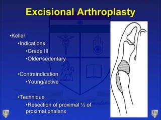 Excisional Arthroplasty
•Keller
•Indications
•Grade III
•Older/sedentary
•Contraindication
•Young/active
•Technique
•Resec...