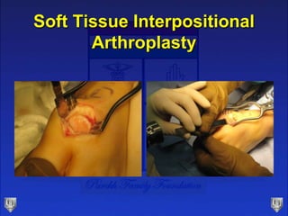 Soft Tissue Interpositional
Arthroplasty
 