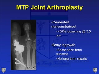 MTP Joint Arthroplasty
•Cemented
nonconstrained
•>50% loosening @ 3.5
yrs
•Bony ingrowth
•Some short term
success
•No long...