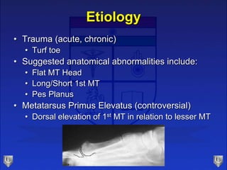 Etiology
• Trauma (acute, chronic)
• Turf toe
• Suggested anatomical abnormalities include:
• Flat MT Head
• Long/Short 1s...