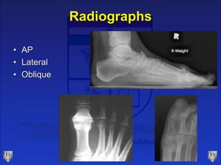 Radiographs
• AP
• Lateral
• Oblique
 