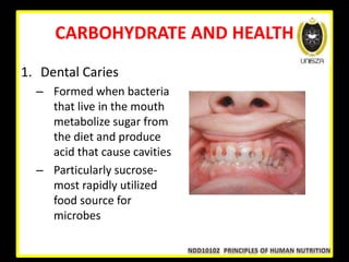 CARBOHYDRATE AND HEALTH
1. Dental Caries
– Formed when bacteria
that live in the mouth
metabolize sugar from
the diet and produce
acid that cause cavities
– Particularly sucrose-
most rapidly utilized
food source for
microbes
 