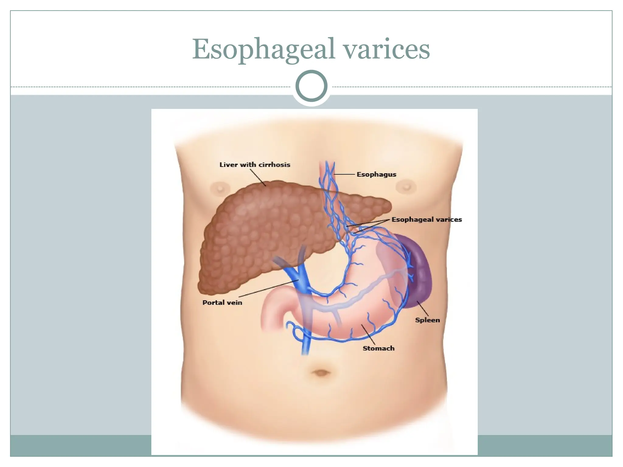 Esophageal varices
 
