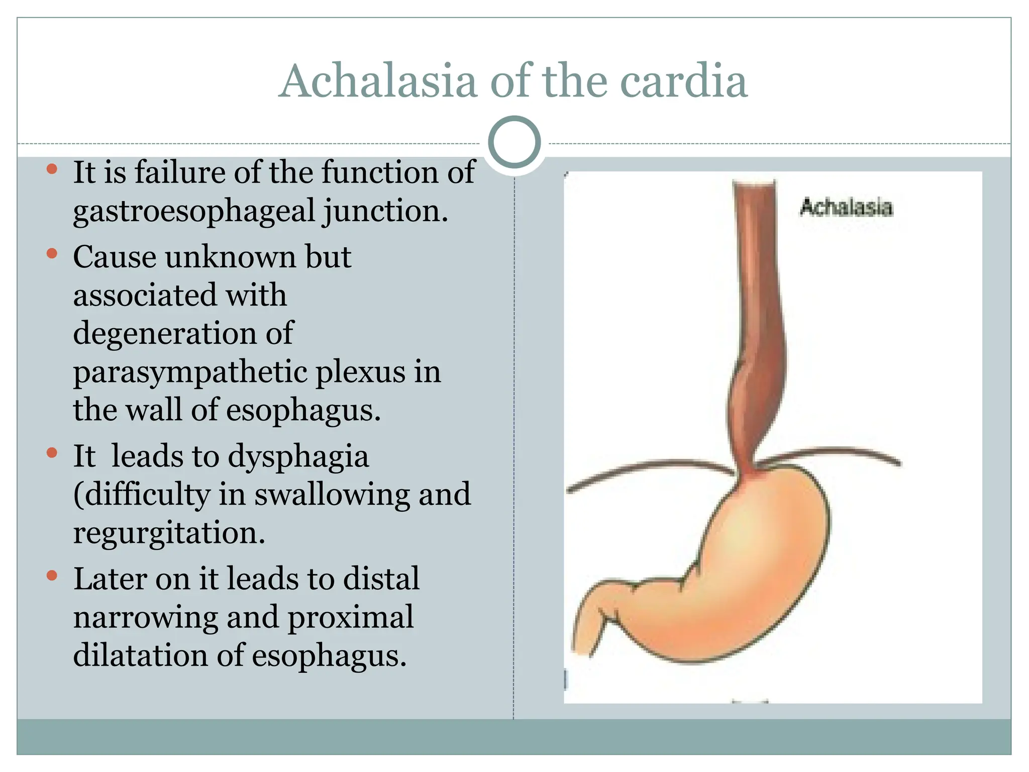 Achalasia of the cardia
 It is failure of the function of
gastroesophageal junction.
 Cause unknown but
associated with
degeneration of
parasympathetic plexus in
the wall of esophagus.
 It leads to dysphagia
(difficulty in swallowing and
regurgitation.
 Later on it leads to distal
narrowing and proximal
dilatation of esophagus.
 