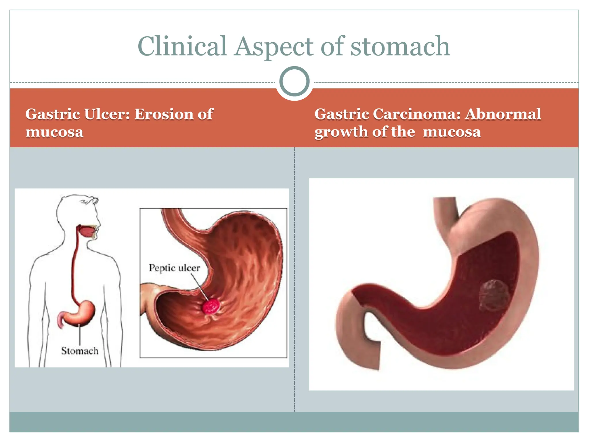 Gastric Ulcer: Erosion of
mucosa
Gastric Carcinoma: Abnormal
growth of the mucosa
Clinical Aspect of stomach
 