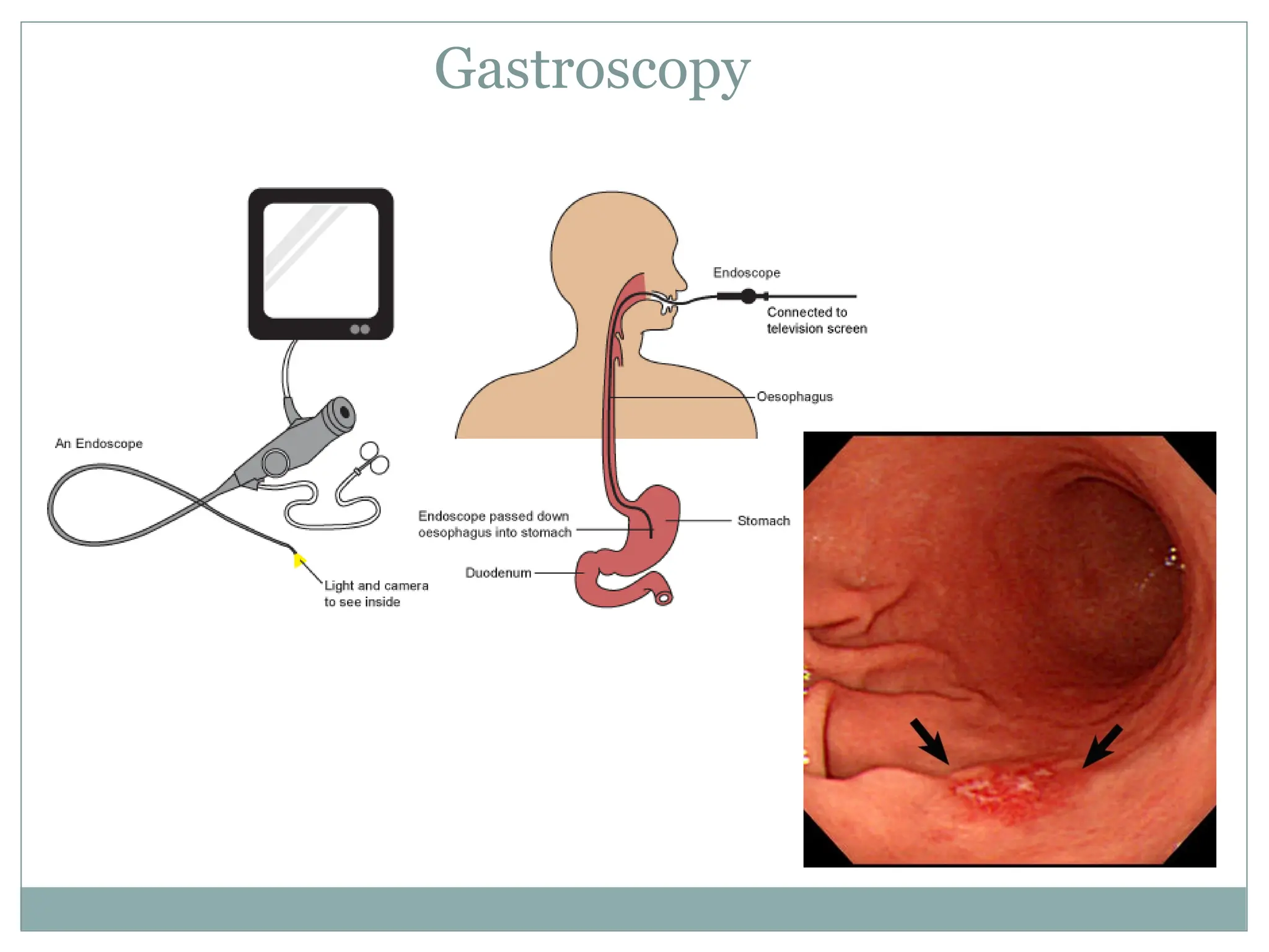 Gastroscopy
 