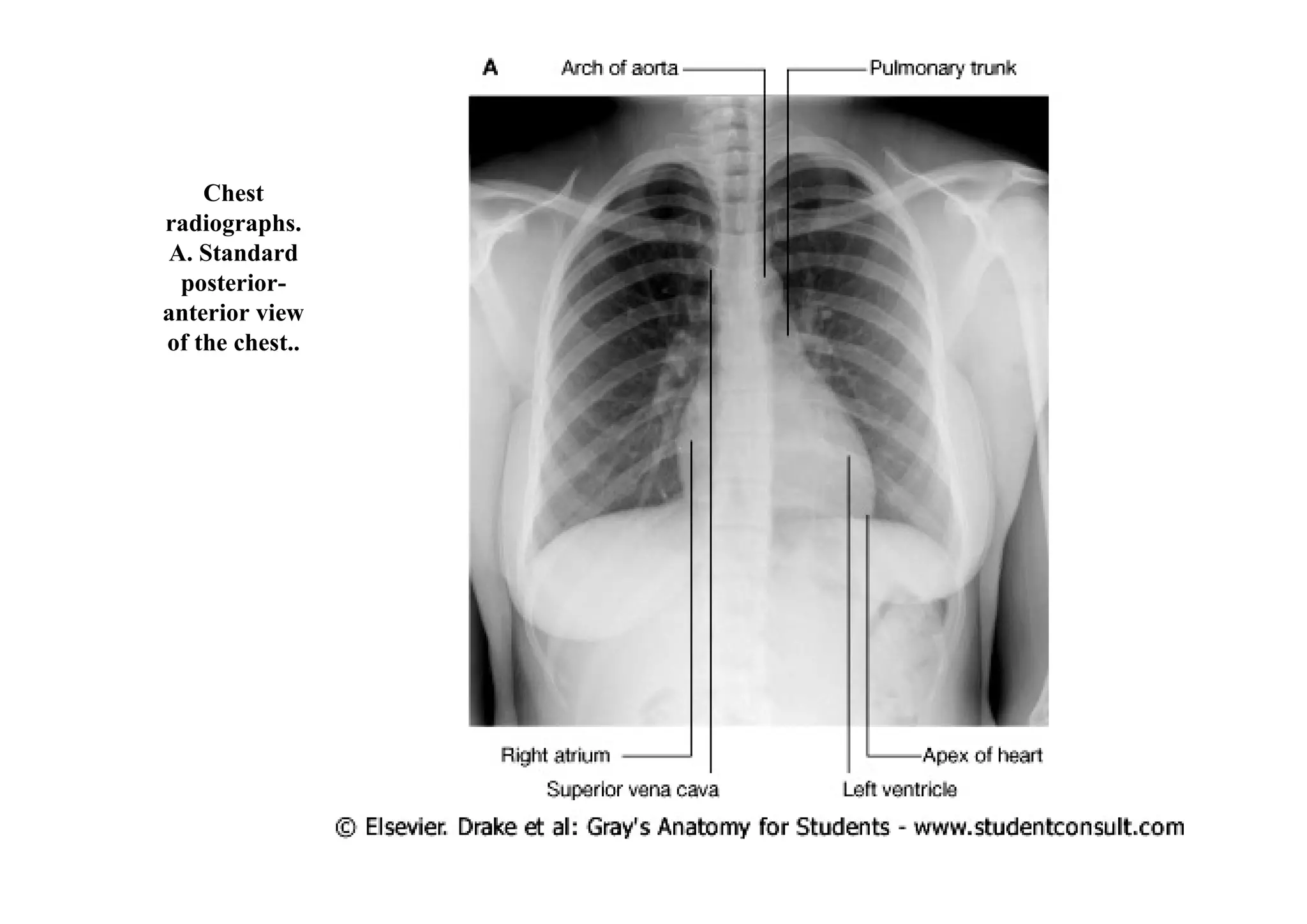 Chest
radiographs.
A. Standard
 posterior-
anterior view
of the chest..
 