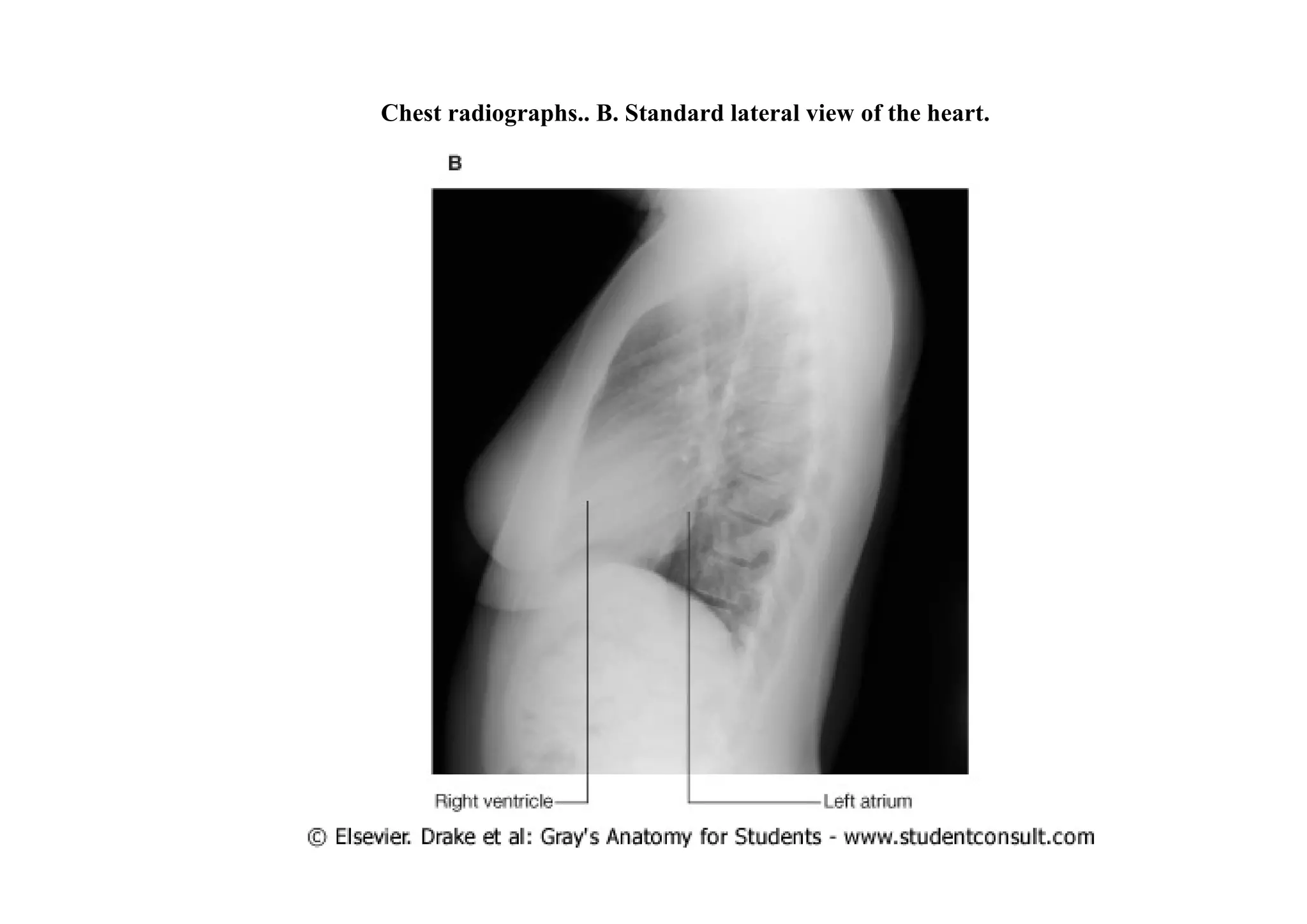 Chest radiographs.. B. Standard lateral view of the heart.
 