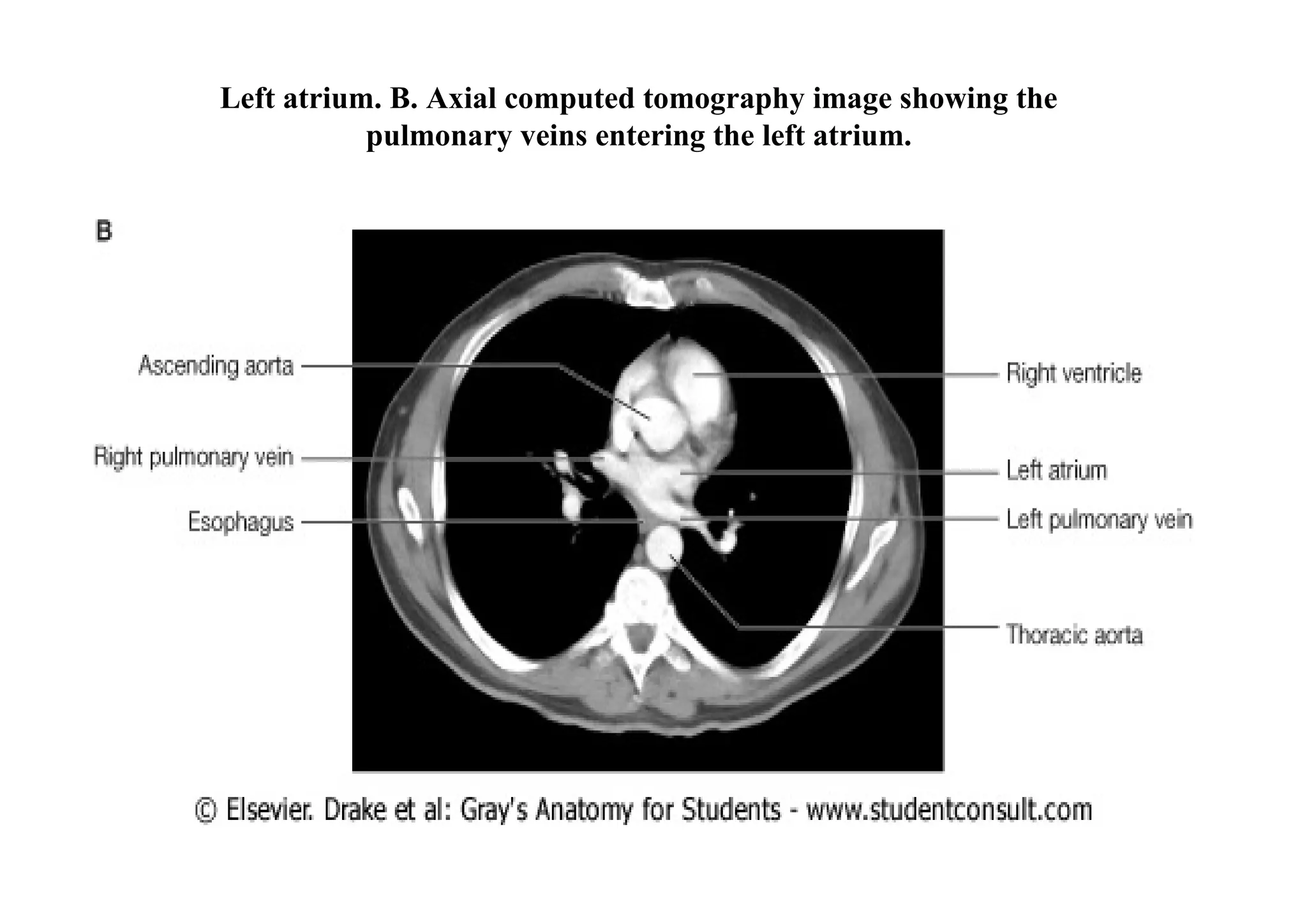 Left atrium. B. Axial computed tomography image showing the
           pulmonary veins entering the left atrium.
 