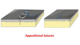 Appositional Pattern Lecture 4; Suture Materials, Suture Needles, Suture Patterns and ...