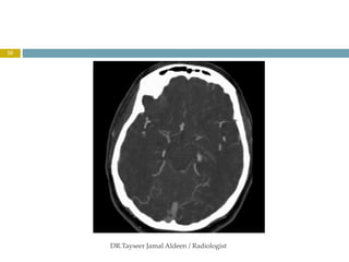 orbital vascular lesions 2