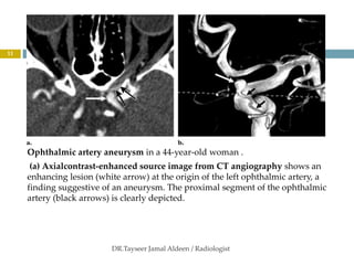 orbital vascular lesions 2