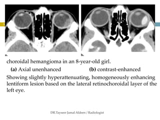 orbital vascular lesions 2