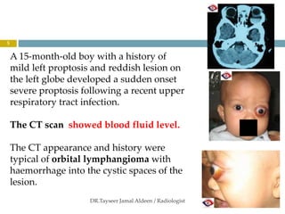 orbital vascular lesions 2