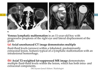 orbital vascular lesions 2