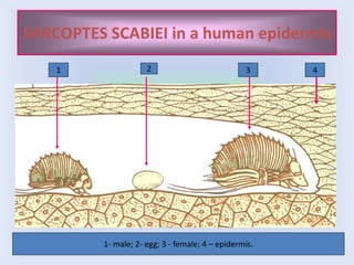 SARCOPTES SCABIEI in a human epidermis
1 3
2 4
1- male; 2- egg; 3 - female; 4 – epidermis.
 