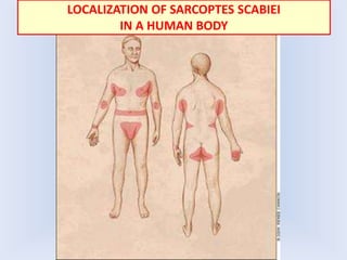 LOCALIZATION OF SARCOPTES SCABIEI
IN A HUMAN BODY
 