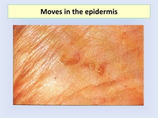 Moves in the epidermis
 