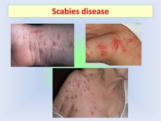 Scabies disease
 