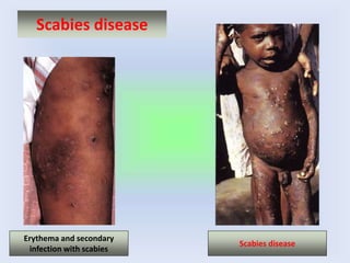 Scabies disease
Erythema and secondary
infection with scabies
Scabies disease
 
