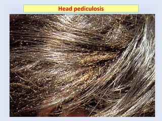 Head pediculosis
 