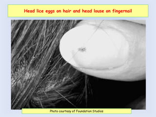 Head lice eggs on hair and head louse on fingernail
Photo courtesy of Foundation Studios
 