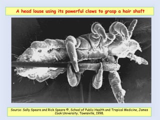 A head louse using its powerful claws to grasp a hair shaft
Source: Sally Speare and Rick Speare ©, School of Public Health and Tropical Medicine, James
Cook University, Townsville, 1998.
 