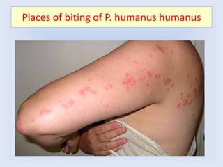 Places of biting of P. humanus humanus
 
