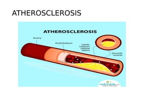 ATHEROSCLEROSIS
 