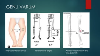 Comprehensive Overview of Lower Limb Deformities: Genu Valgum, Varum ...