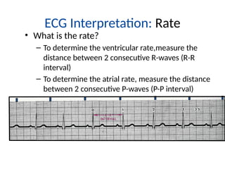 Two Consecutive R Waves Lecture 5 Ecg lecture ECG Lecture Educational.pptx