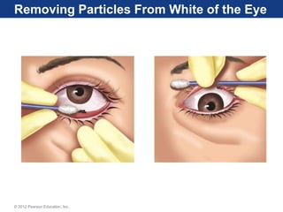 Removing Particles From White of the Eye
© 2012 Pearson Education, Inc.
 