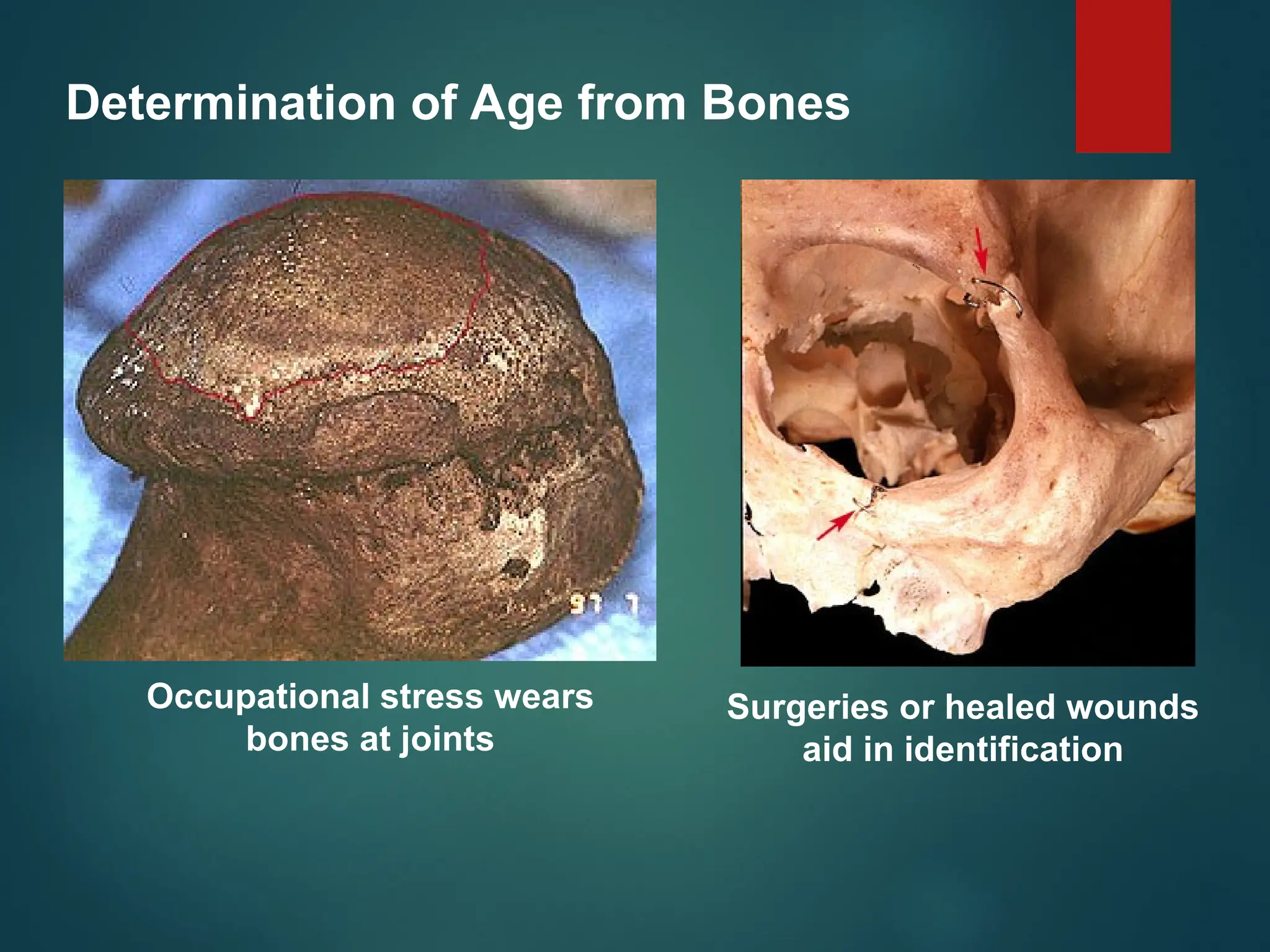 Determination of Age from Bones
Occupational stress wears
bones at joints
Surgeries or healed wounds
aid in identification
 