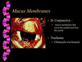 Mucus Membranes
 D. Conjunctiva –
• mucus membranes that
cover the eyeball and lines
the eyelid
 Trachoma
• Chlamydia trachomatis
 