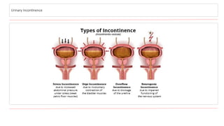 Comprehensive Overview of Benign Prostatic Hyperplasia and Lower ...