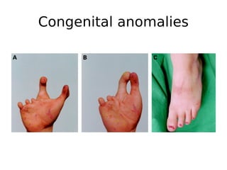 Congenital anomalies
 